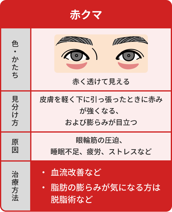 赤クマは赤く透けて見えて皮膚を軽く下に引っ張った時に赤みが強くなる、および膨らみが目立つ。原因は眼輪筋の圧迫や睡眠不足や疲労、ストレスなど、治療方法は血流改善や脂肪のふくらみが気になる方は脱脂術など