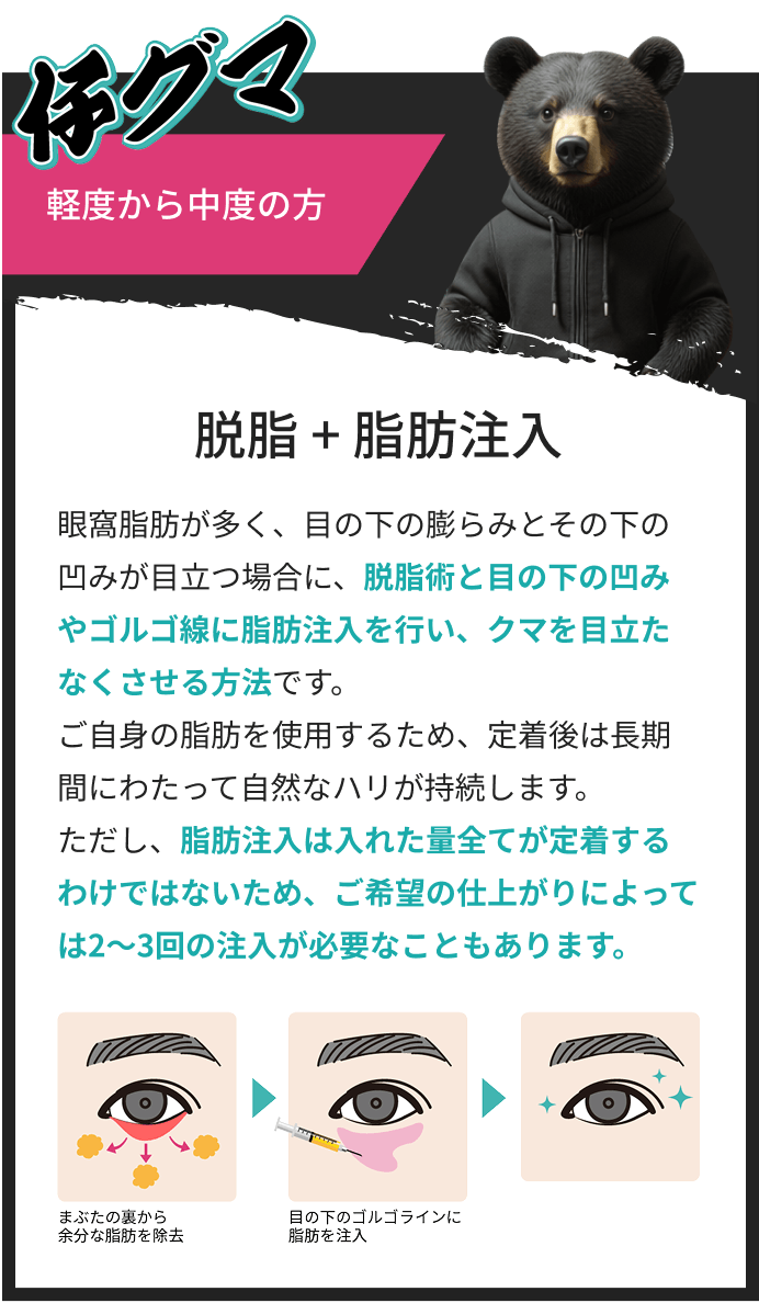 仔熊軽度から中度の方は脱脂+脂肪注入
