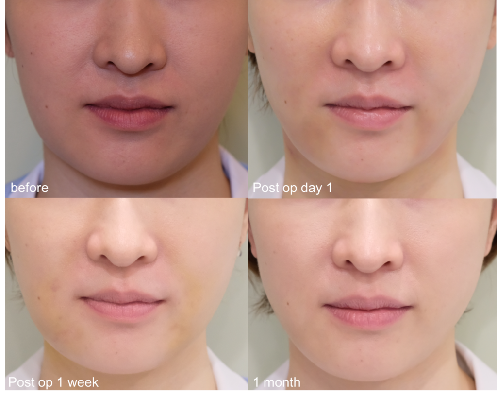 顔の脂肪吸引と糸のリフトを併用してタルミ解消と小顔効果 美容整形なら銀座マイアミ美容外科
