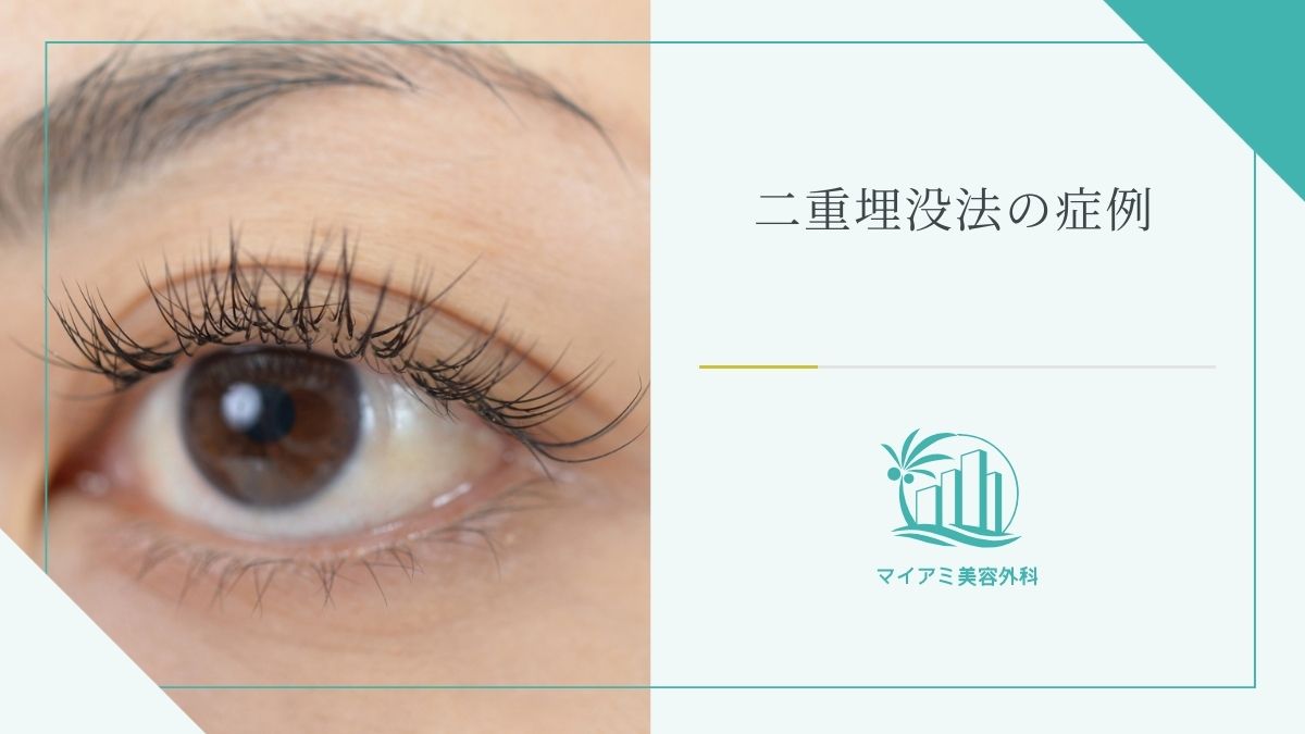 二重整形・埋没法の症例