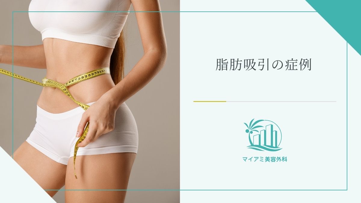 脂肪吸引の症例