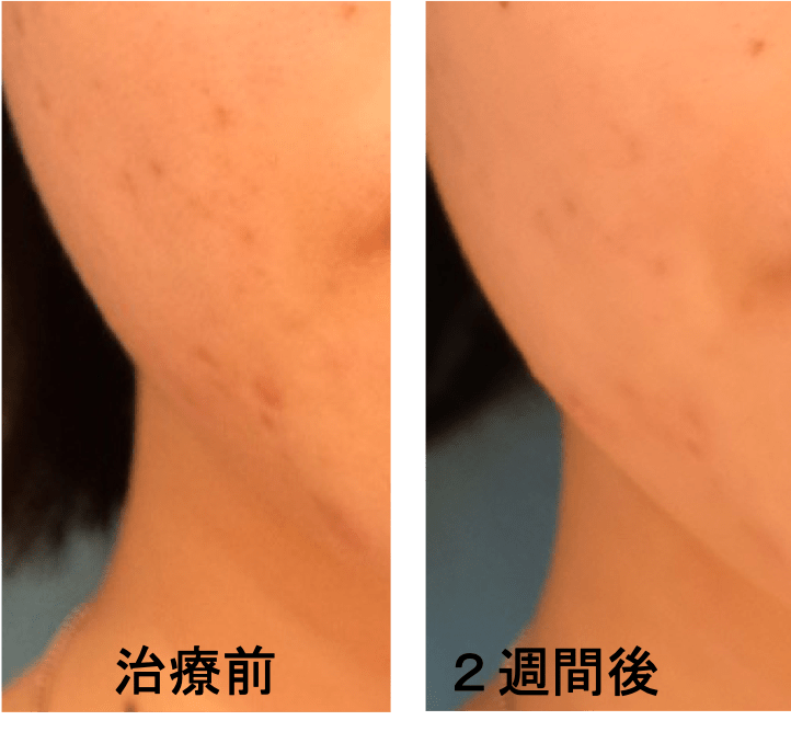 プラズマシャワーで美肌治療 美容整形なら銀座マイアミ美容外科 プラズマシャワーで美肌治療 美容整形なら銀座マイアミ美容外科
