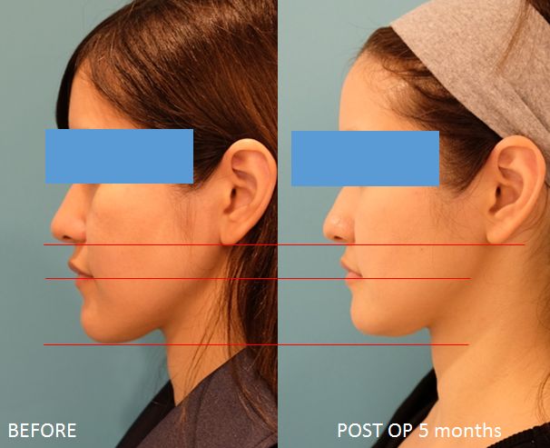 顔の下1/3のバランス最適化の中抜きオトガイ形成