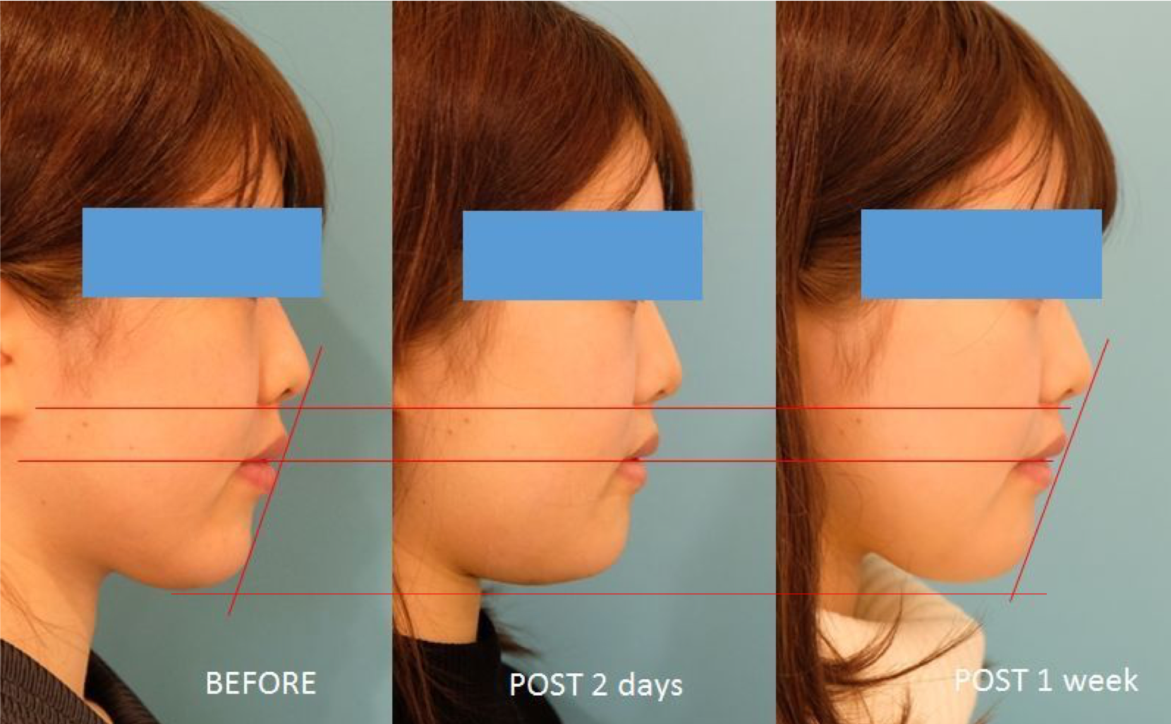 手術後早期から効果が出る 顎の中抜き 2日後 １週間後の経過 美容整形なら銀座マイアミ美容外科