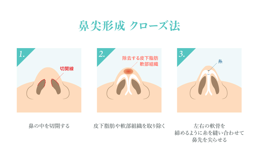 鼻尖形成 クローズ法