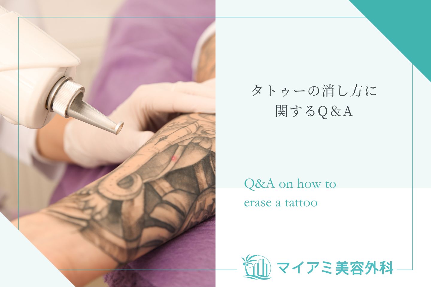 タトゥーの消し方に関するQ＆A