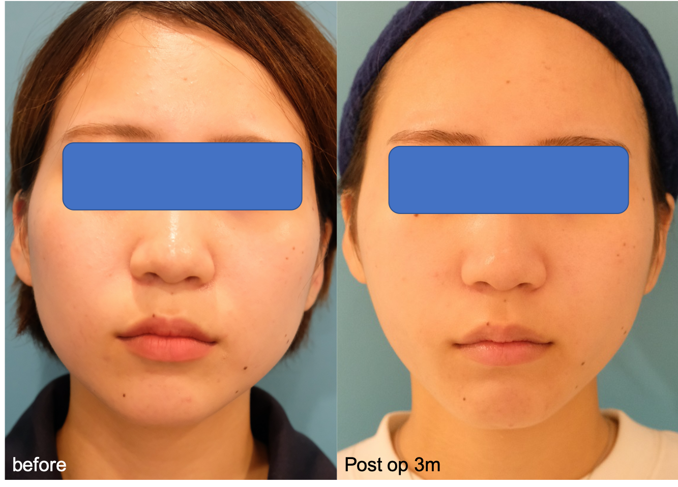 小顔セットの小顔効果 色々なケースをお見せします 美容整形なら銀座マイアミ美容外科