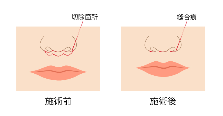 人中短縮で 唇を上向きにする ことはできますか 美容整形なら銀座マイアミ美容外科