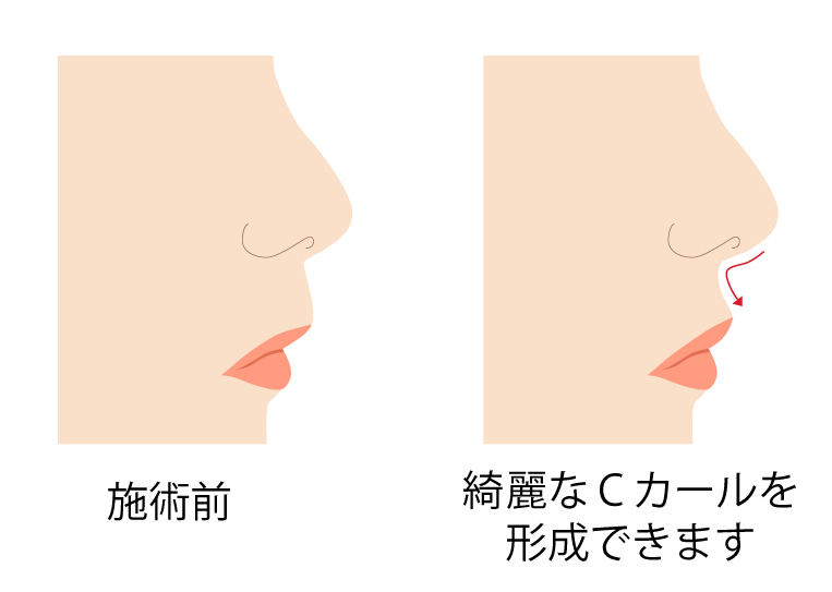 人中短縮の切る場所は 傷あとは 銀座マイアミ美容外科