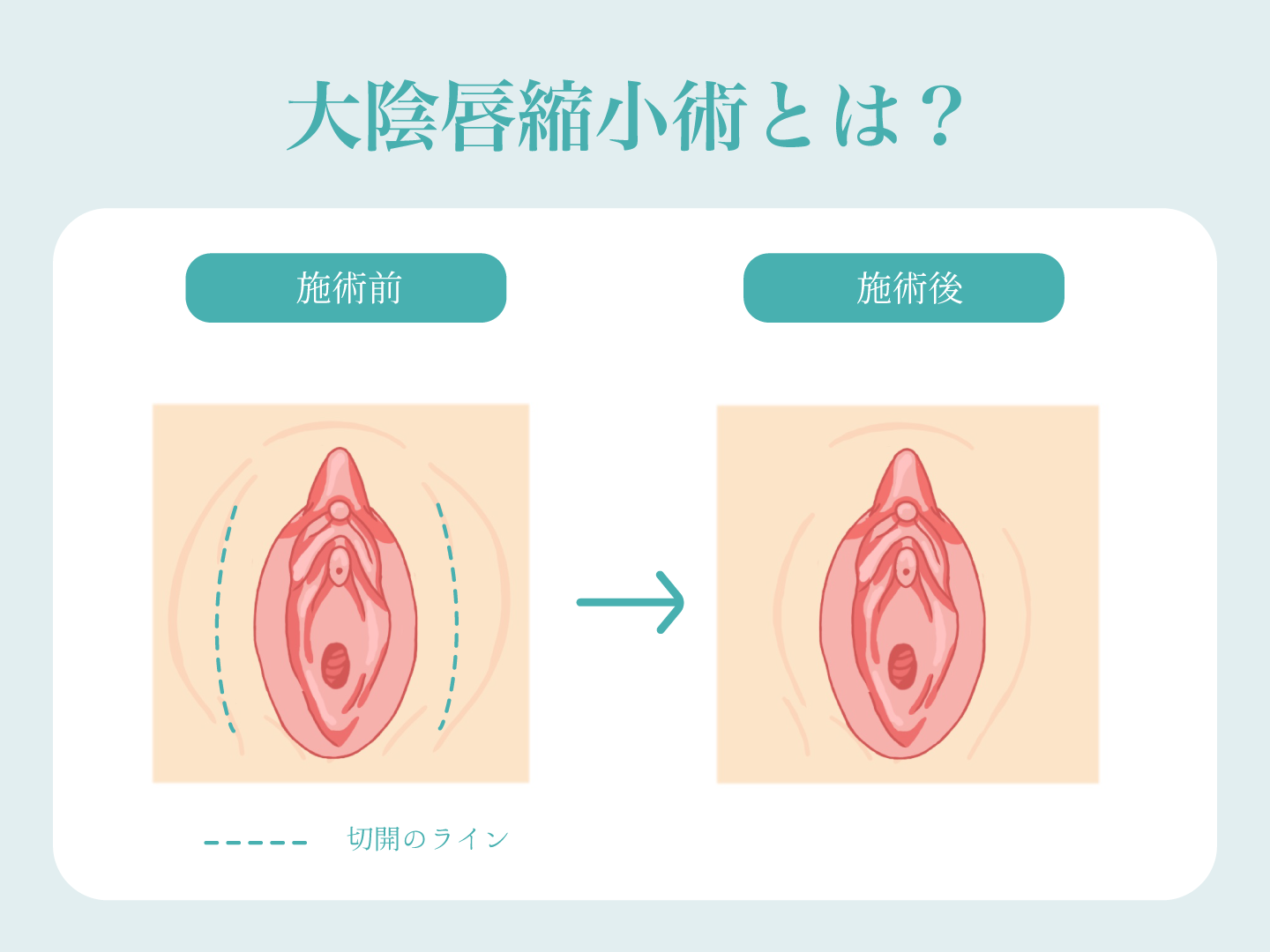 大陰唇縮小とは？