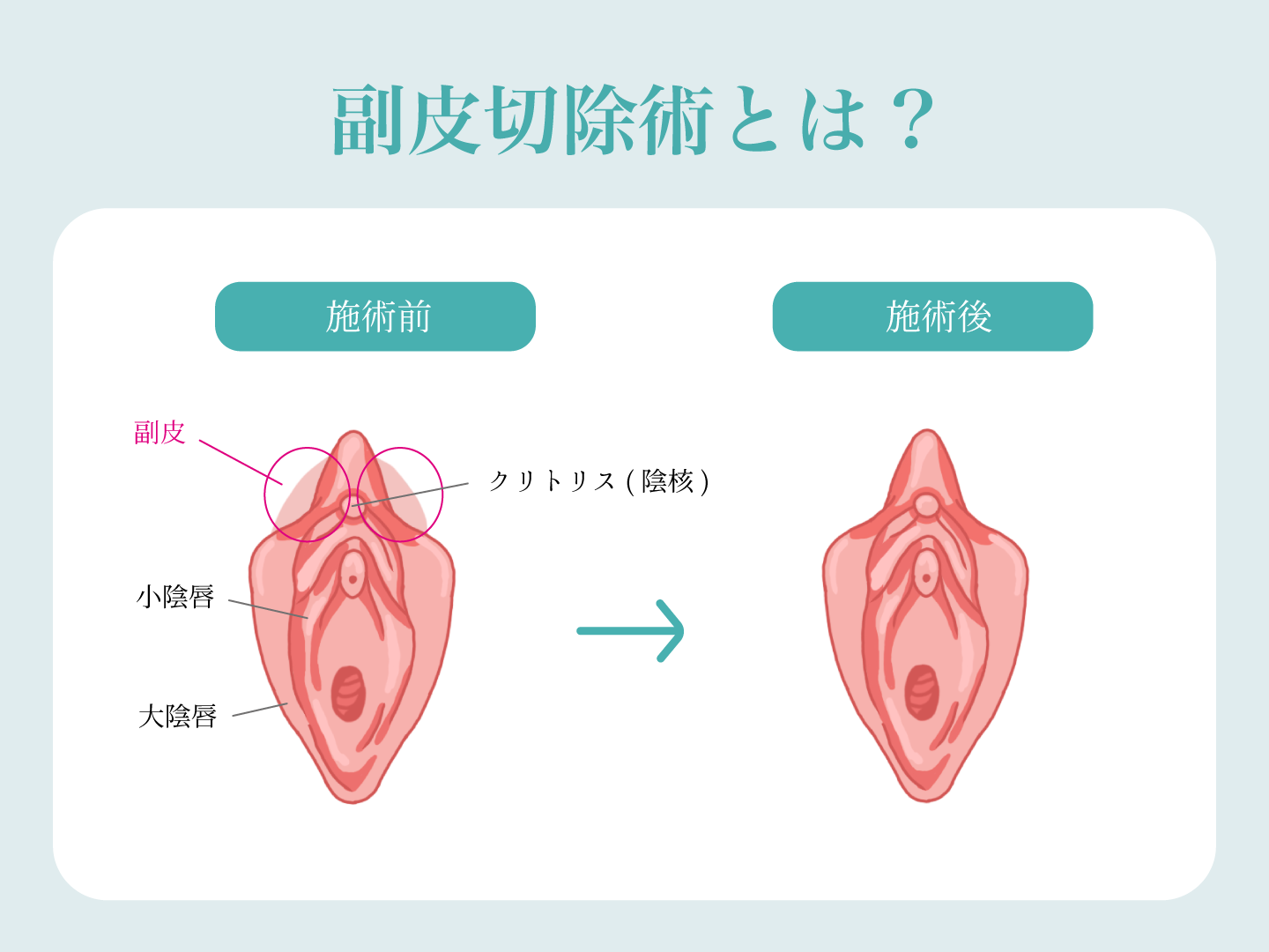 副皮切除とは？