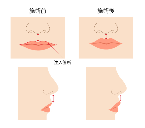 切らない人中短縮のイラスト