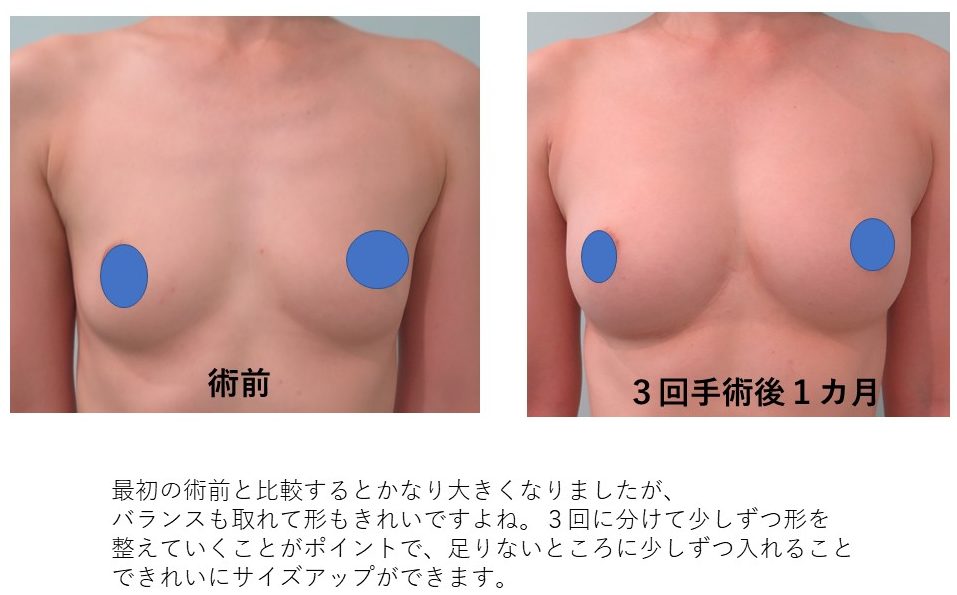 3回ばれない豊胸をした方の経過 美容整形なら銀座マイアミ美容外科