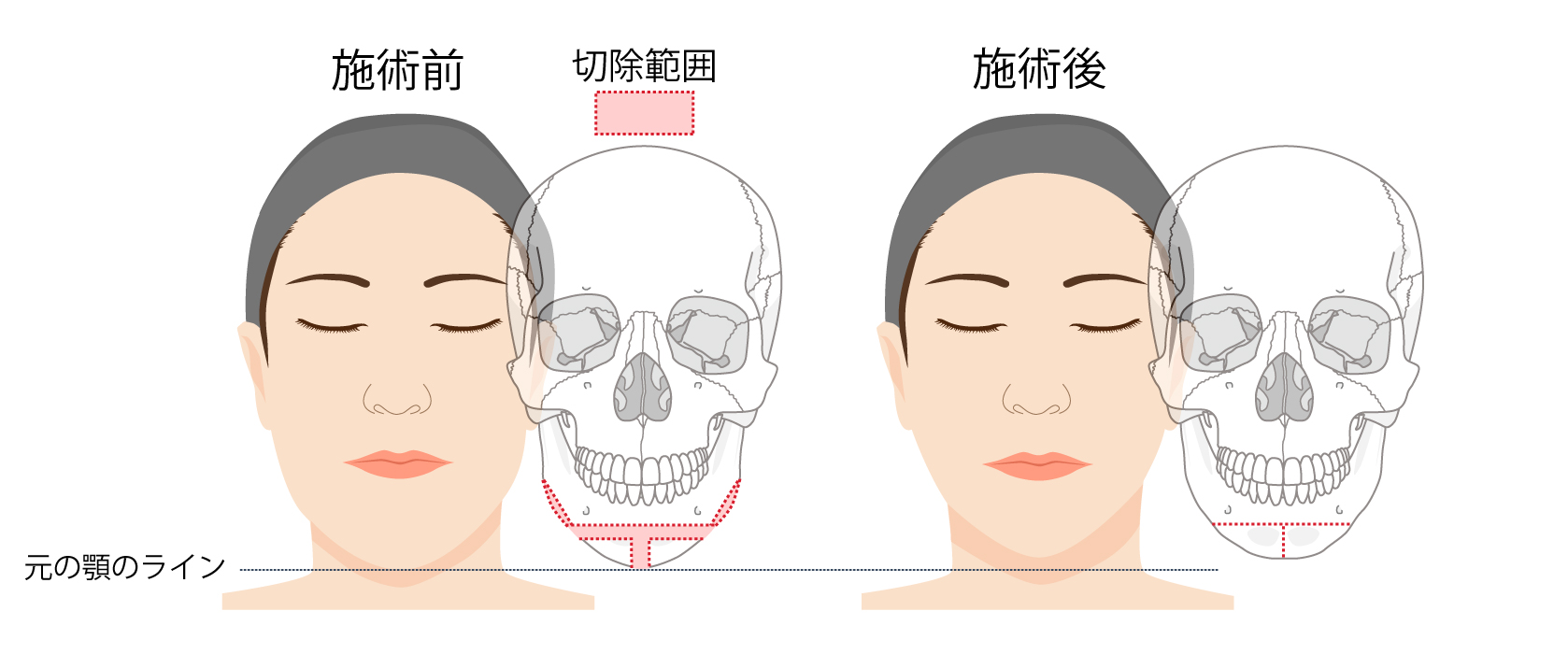 Vライン形成にはどのような手術がありますか 美容整形なら銀座マイアミ美容外科