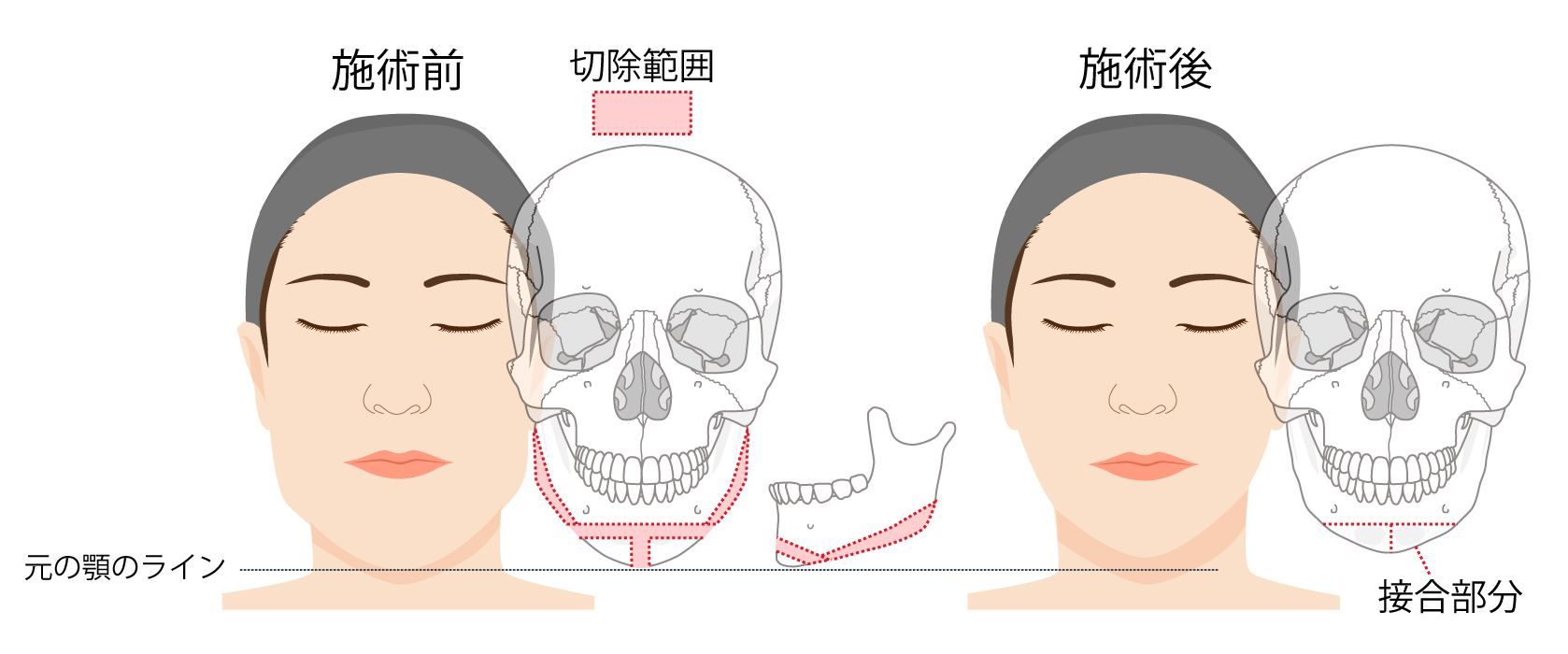 骨切り後の左右差が気になっています 銀座マイアミ美容外科