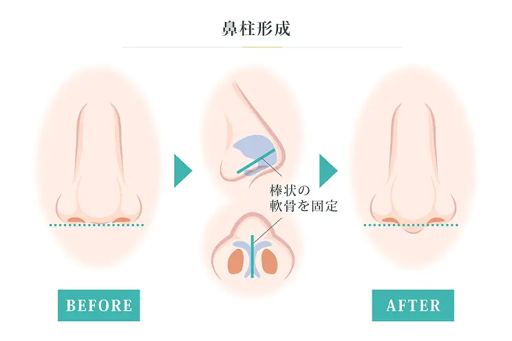 鼻柱形成