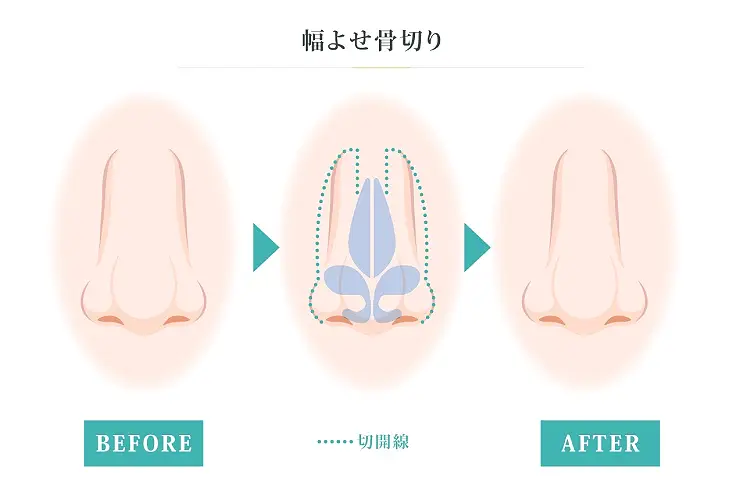 幅よせ骨切り