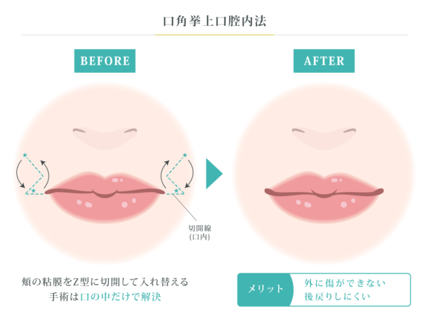 口角挙上口腔内法