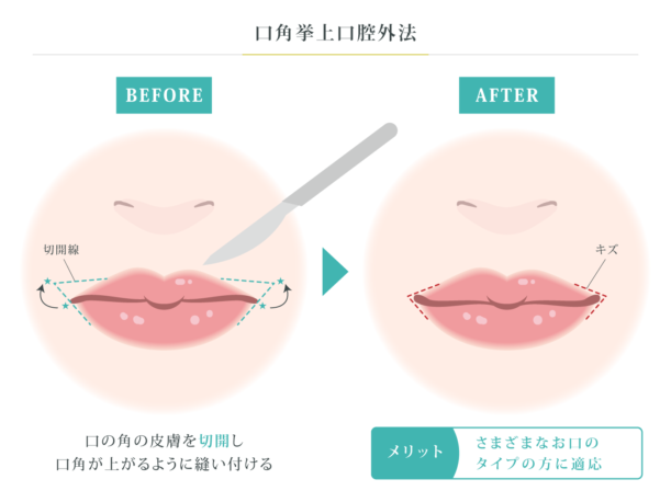 口角挙上口腔外法