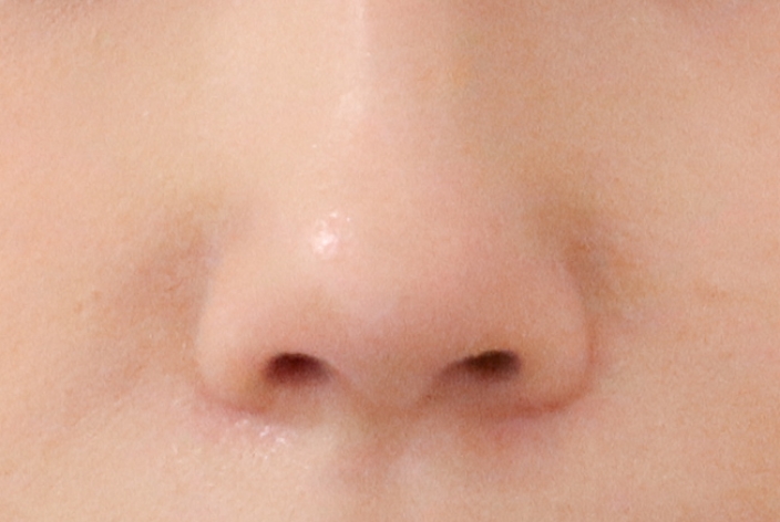 鼻孔縁下降術施術後イメージ