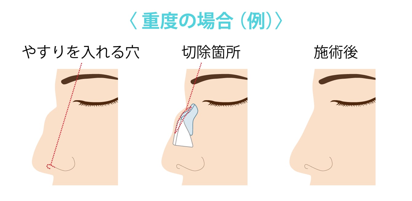 鷲鼻 と は