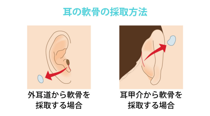 耳介軟骨移植_耳の軟骨の採取方法