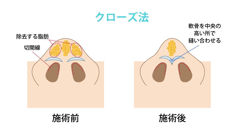 鼻尖形成の手術（クローズ法）