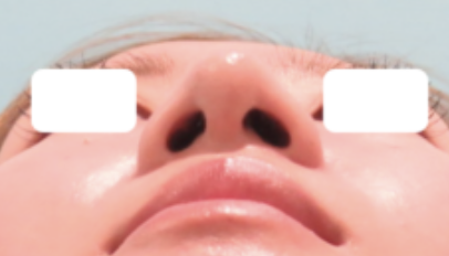 鼻尖形成・耳介軟骨移植施術後イメージ