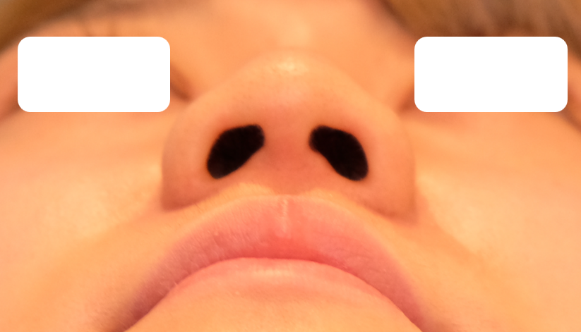 鼻尖形成・耳介軟骨移植施術前イメージ