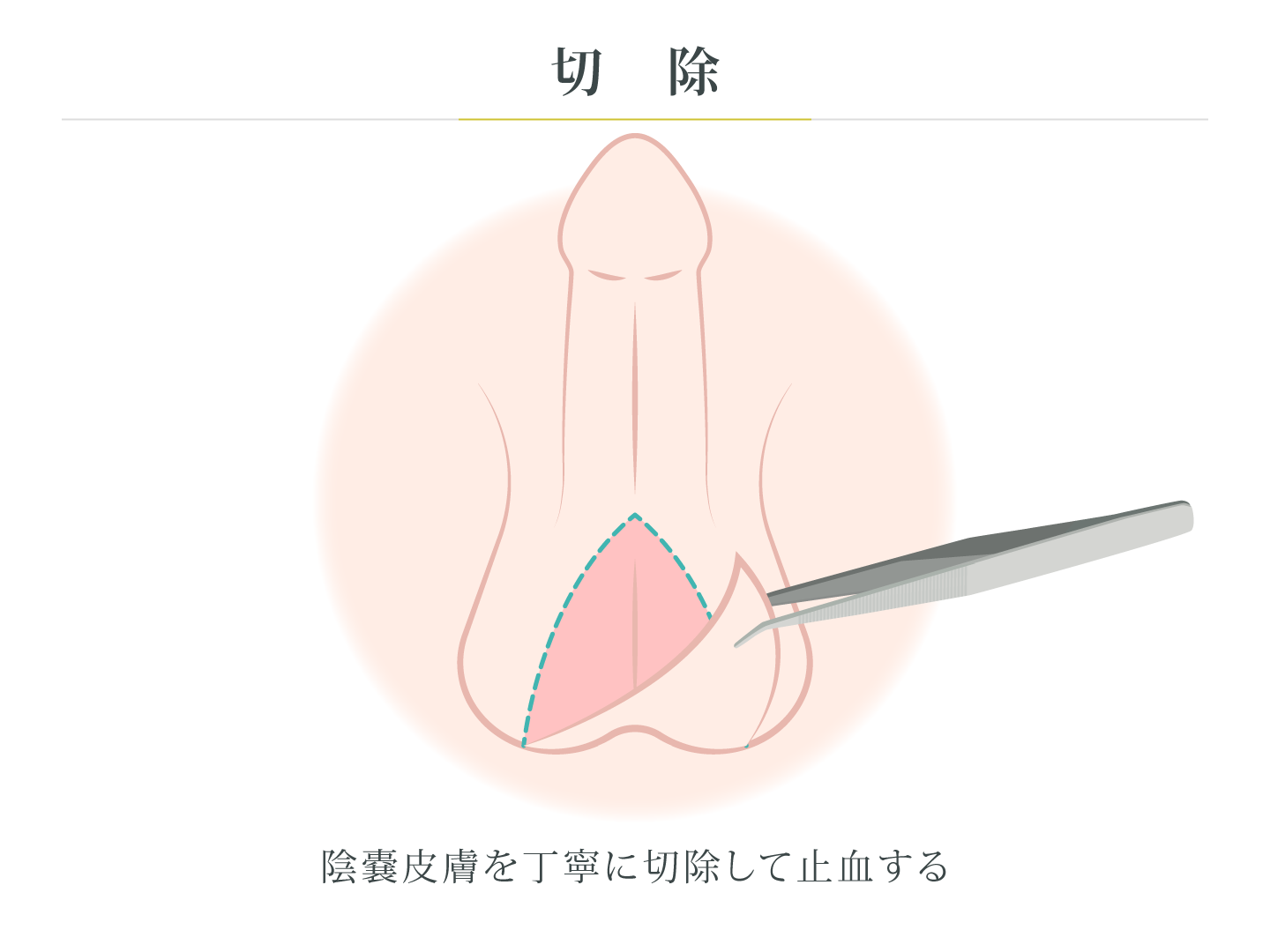 illustration_切除