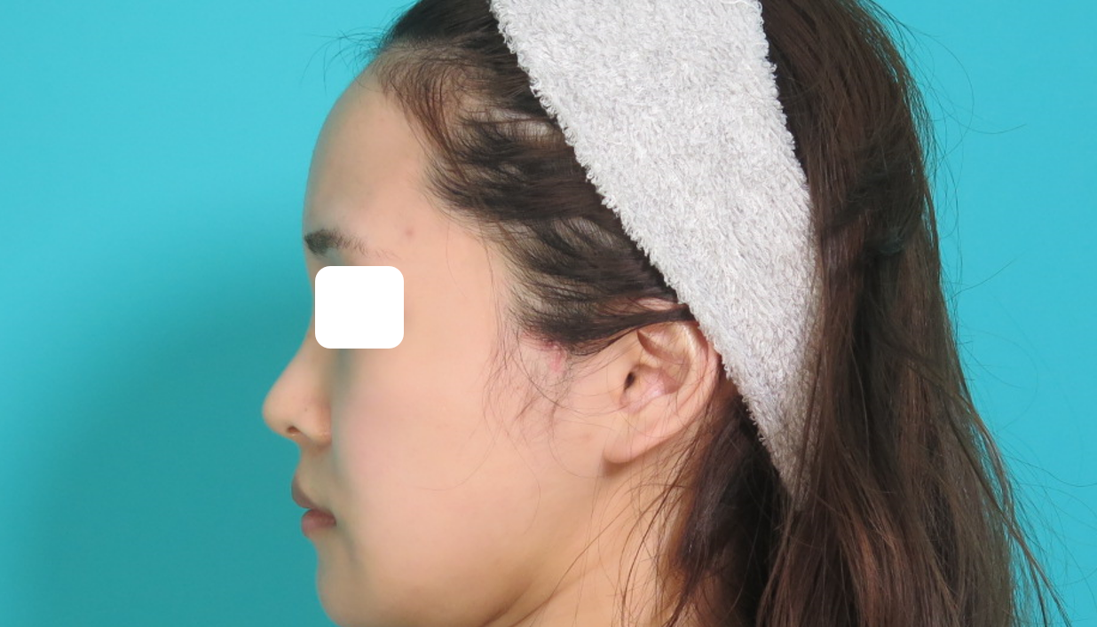 耳介軟骨移植施術後イメージ