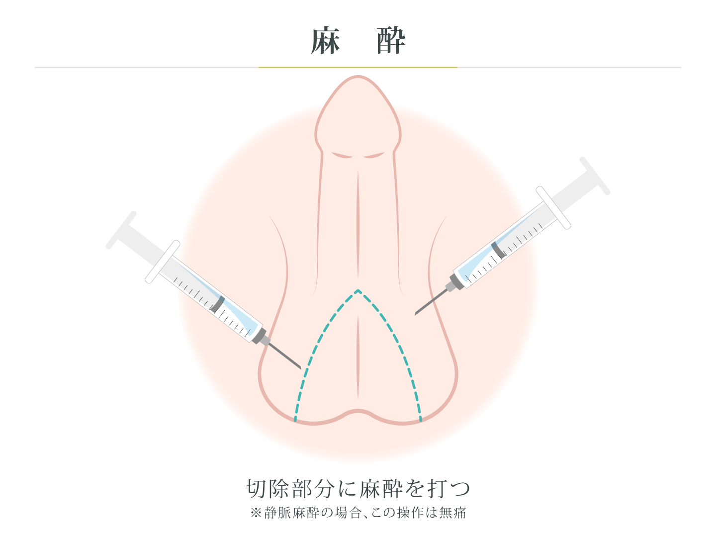 illustration_麻酔