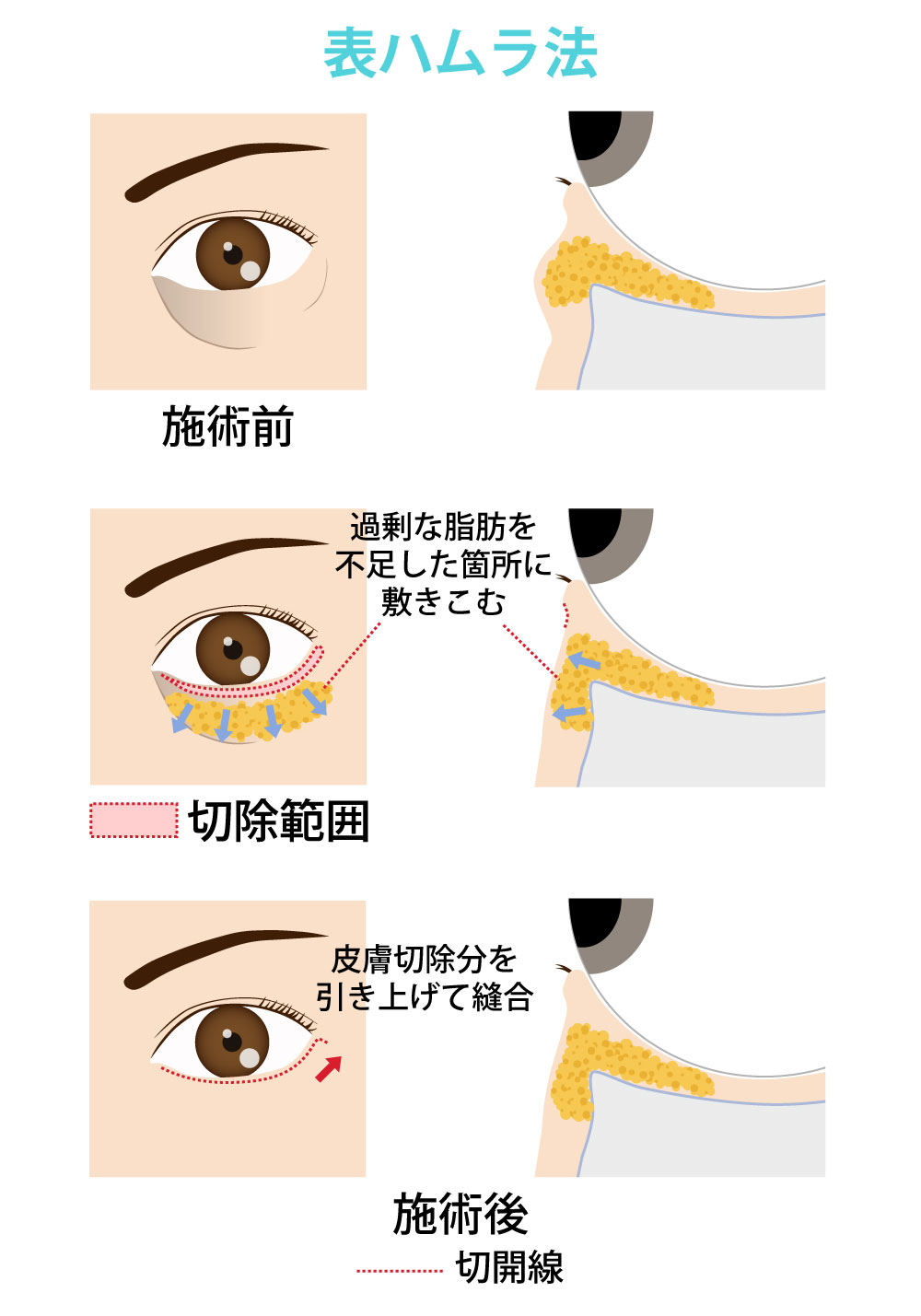 まぶたの若返り_表ハムラ法