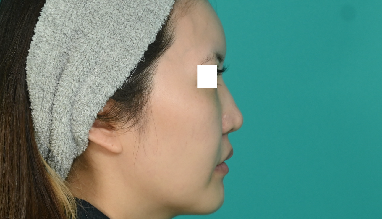 鼻フルコース忘れ鼻：緩やかなカーブを描く鼻スジをハンプ削りと耳介軟骨移植で作成できます。施術前イメージ
