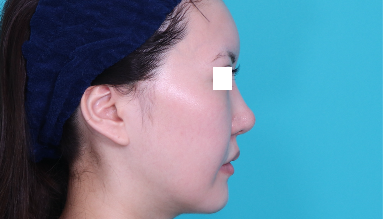 鼻フルコース忘れ鼻：緩やかなカーブを描く鼻スジをハンプ削りと耳介軟骨移植で作成できます。施術後イメージ