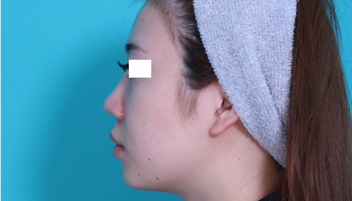 アップノーズ修正も鼻フルコースで出来ます。施術前イメージ