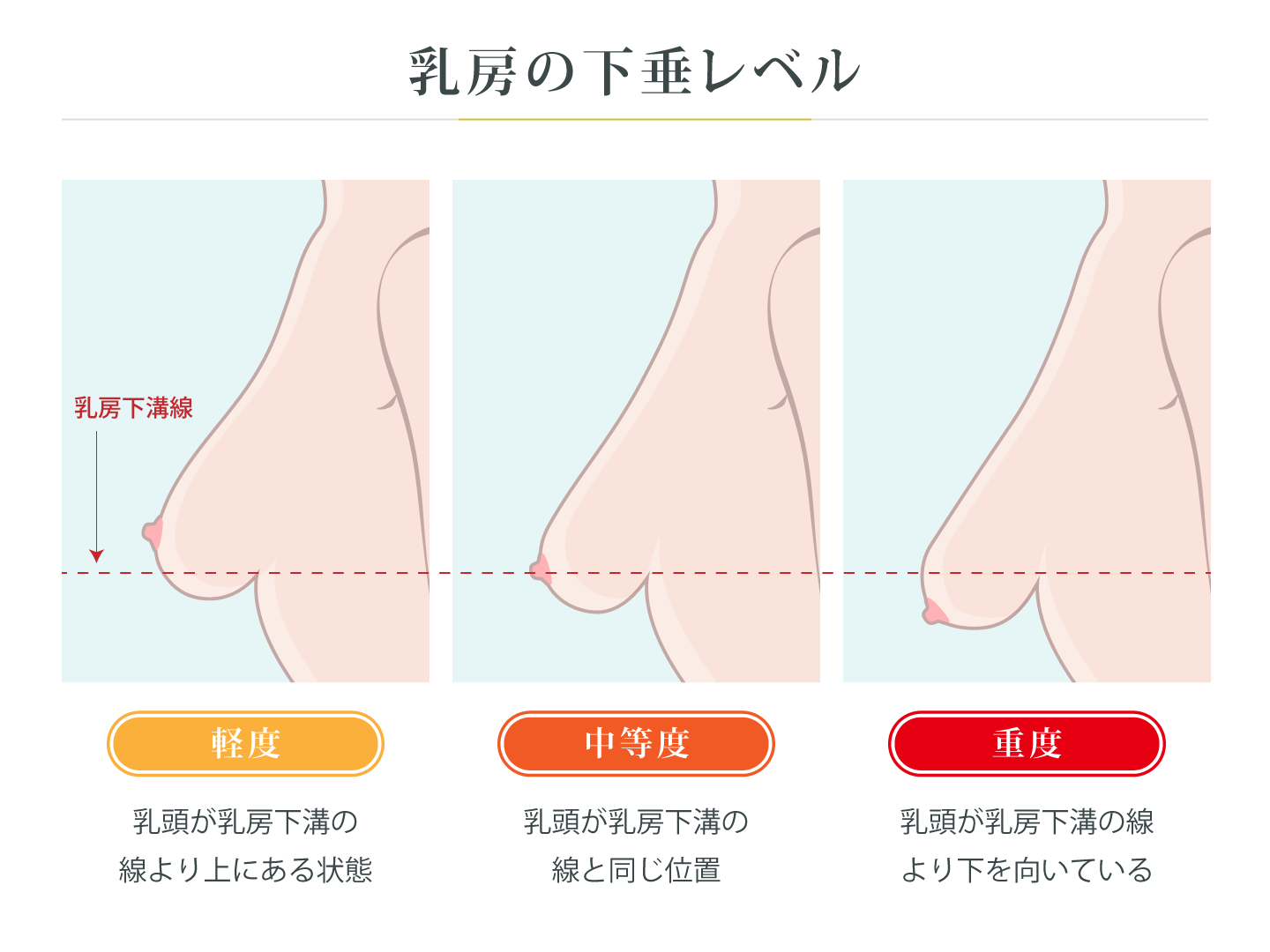 乳房の下垂レベルのイラスト