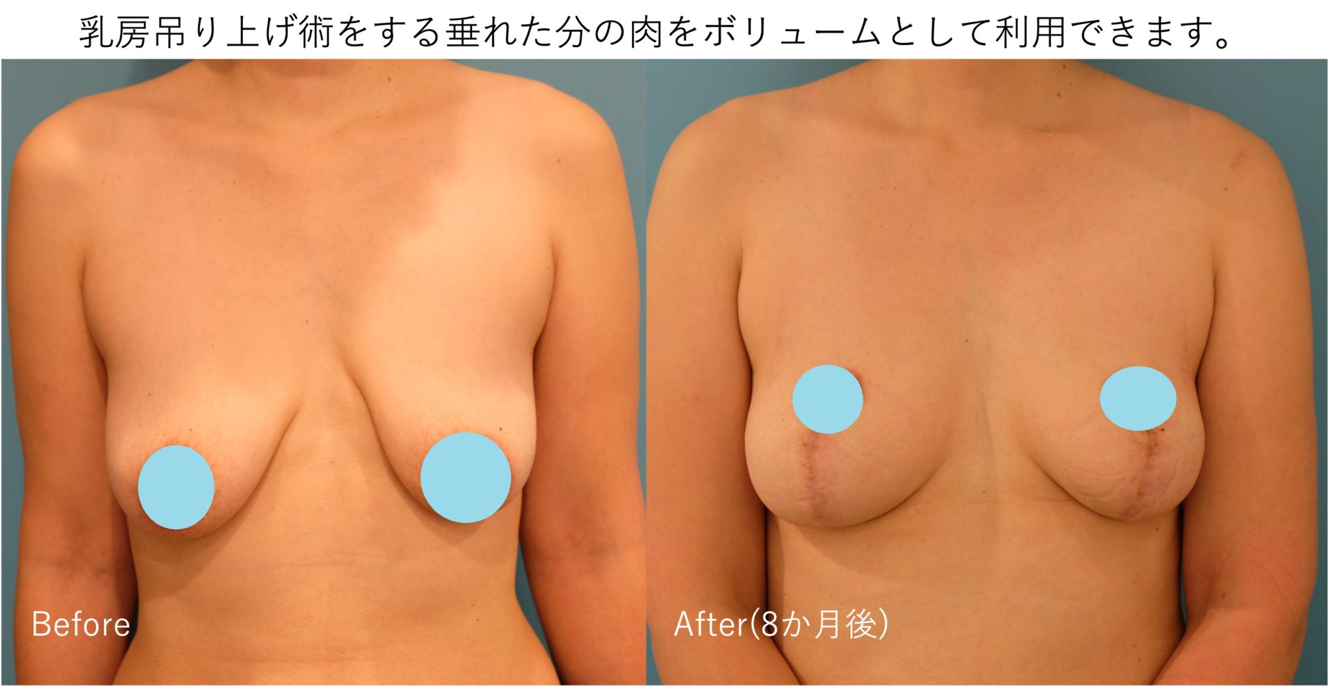 乳房吊り上げは、垂れた分の肉を吊り上げつつボリュームとして利用できます。施術前後イメージ