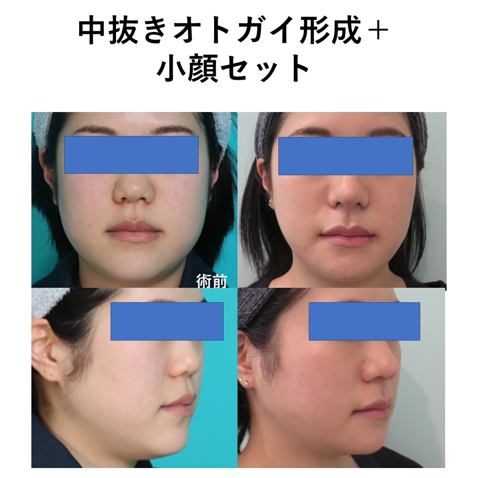 顔の余白を減らす手術施術前後イメージ