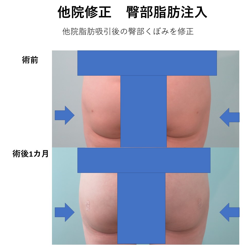 他院脂肪吸引後のお尻の凹み修正（豊尻術）施術前後イメージ