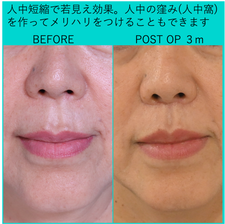 人中短縮・人中窩形成の症例写真