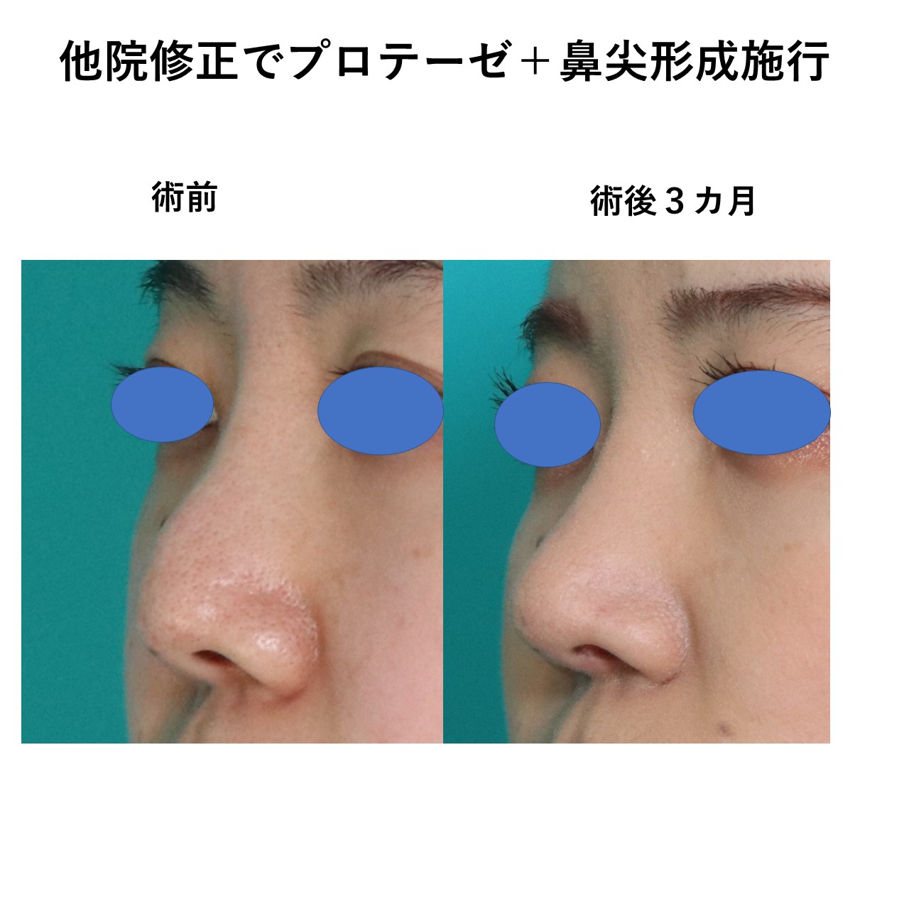 鼻の他院修正プロテーゼ入れ替えと鼻尖形成施術前後イメージ