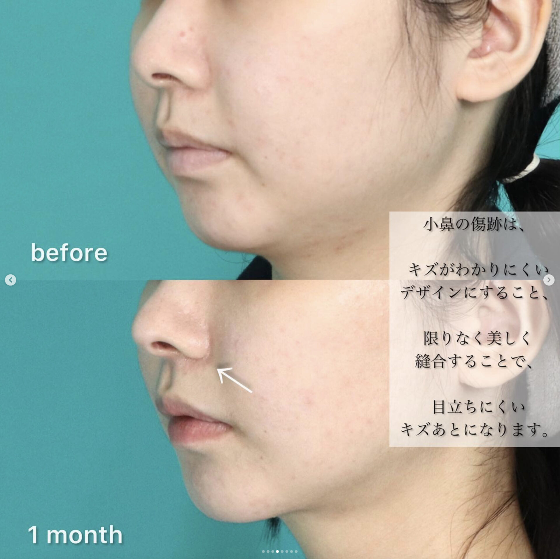 鼻フルコースベーシック、小顔セット施術前後イメージ