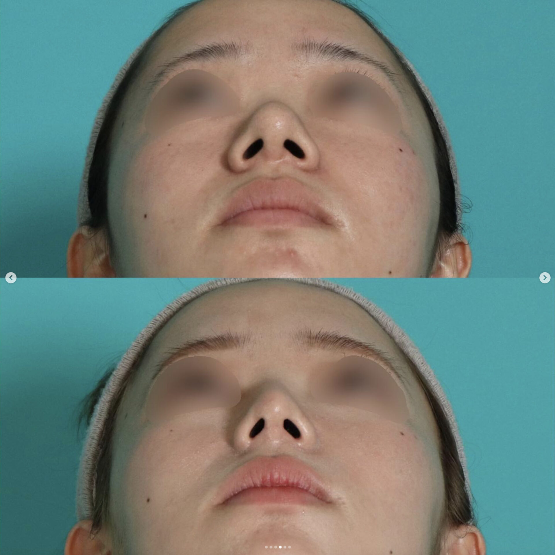 鼻プロテーゼ入替え（他院修正）＋鼻尖形成＋小鼻縮小施術前後イメージ