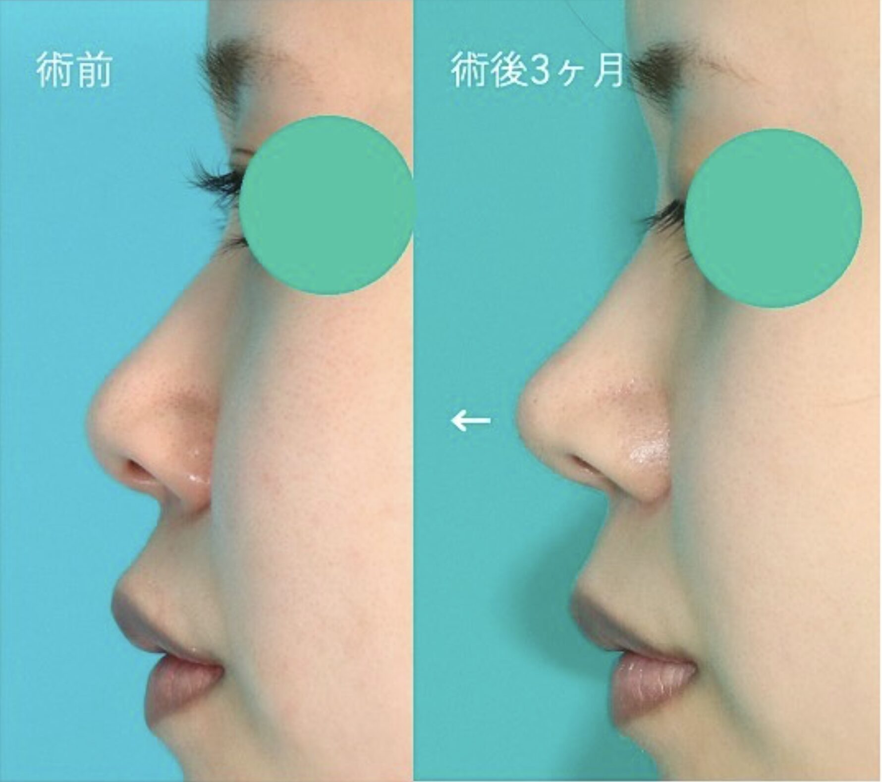 鼻フルコース（ベーシック）施術前後イメージ