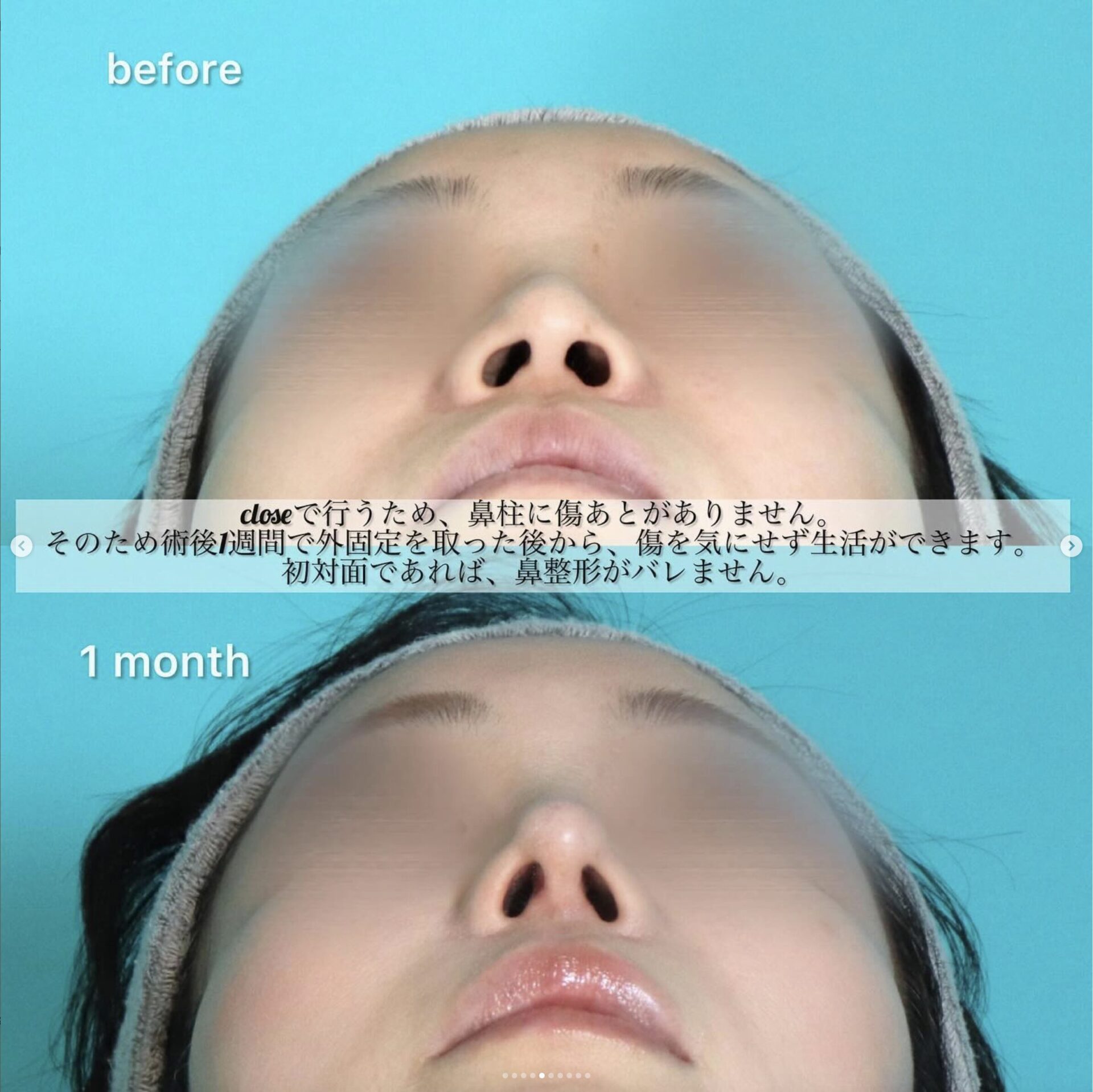 鼻フルコース（プレミアム）施術前後イメージ