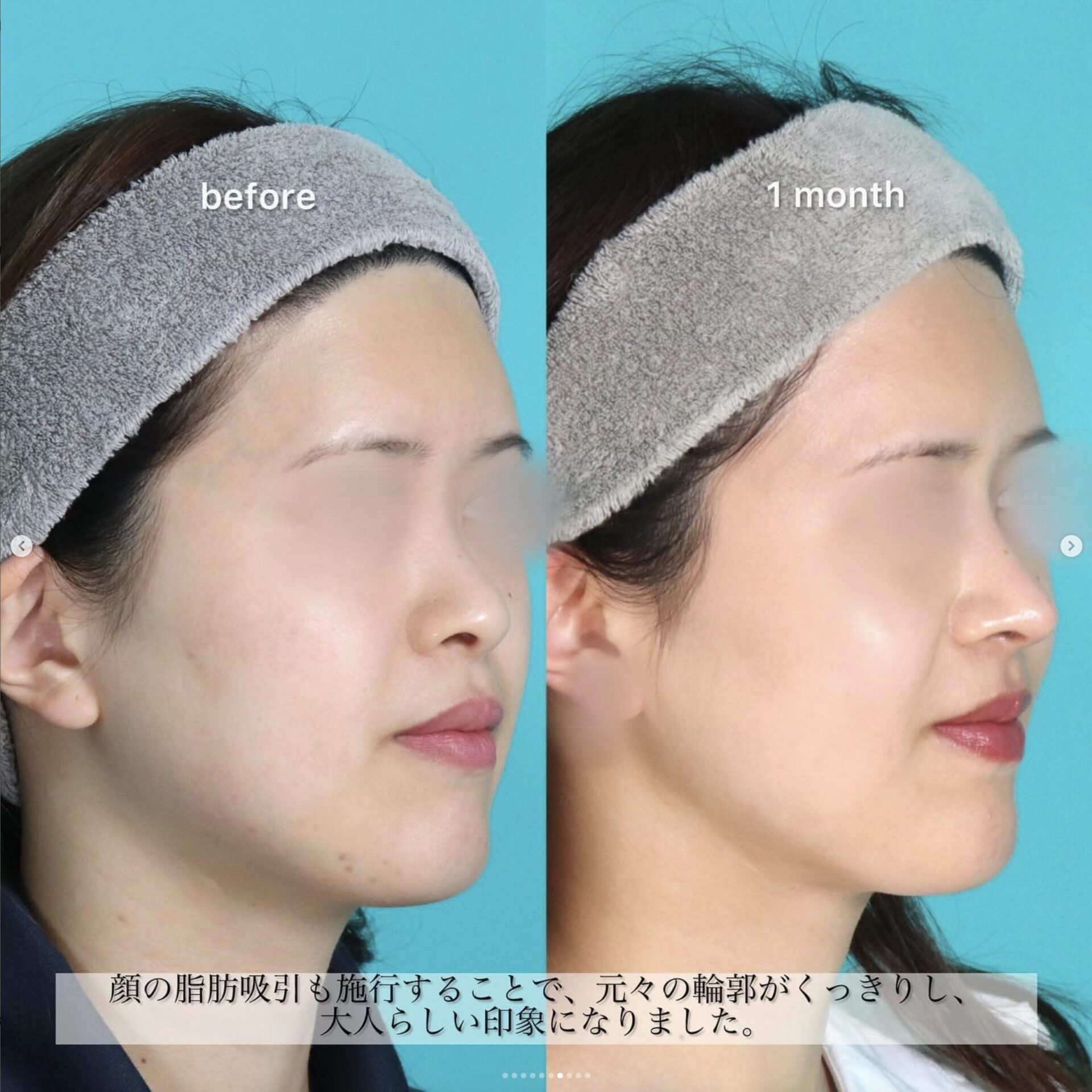 鼻フルベーシック（ベーシック）、小顔セット施術前後イメージ