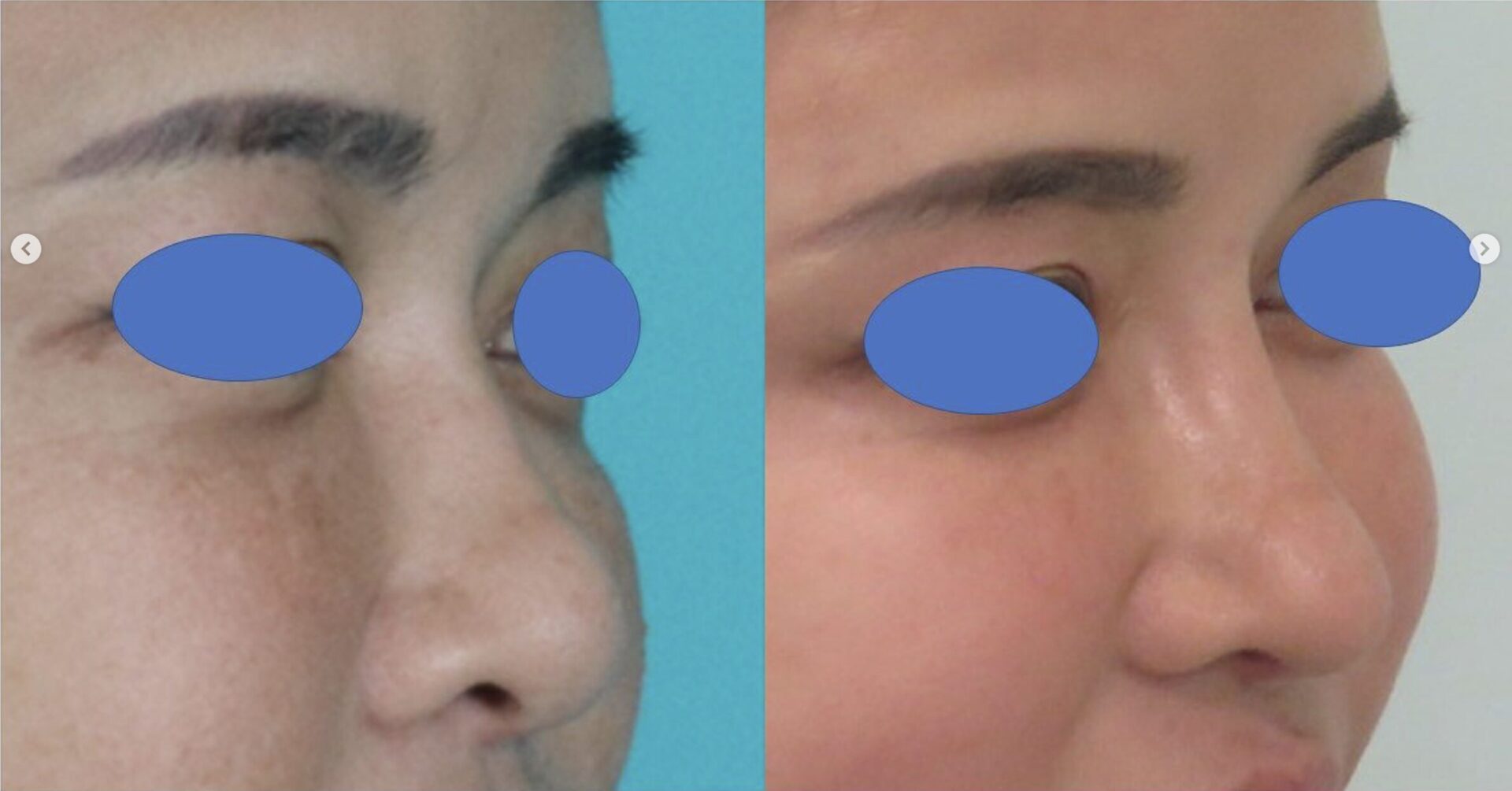 鼻フルコース（ベーシック）施術前後イメージ