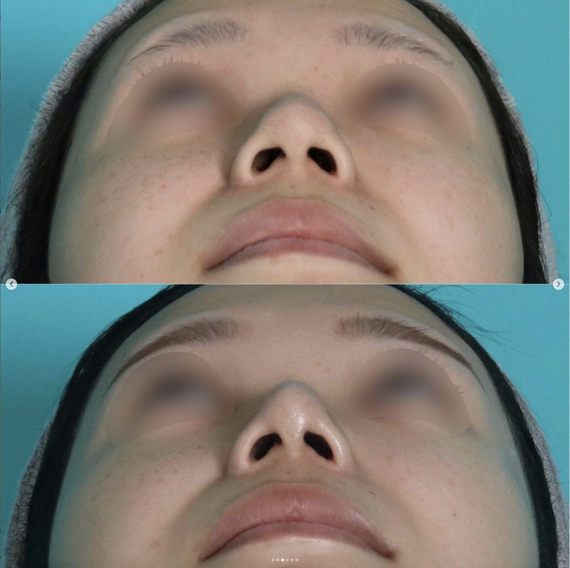 鼻尖形成施術前後イメージ