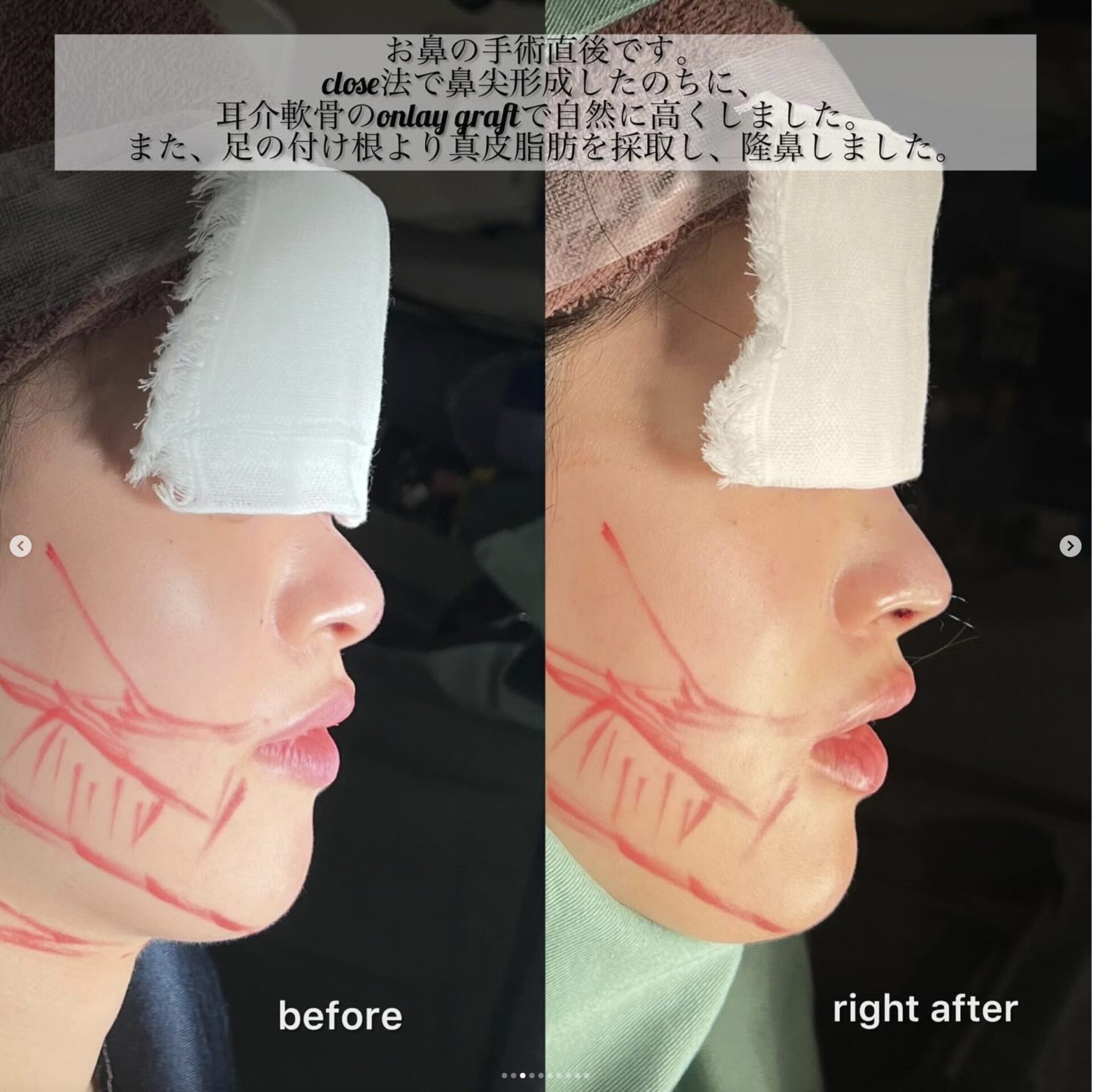 鼻フルコース（ベーシック）、小顔セット施術前後イメージ